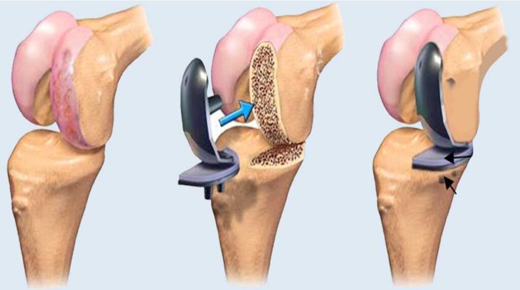 Best Joint Replacement Surgeon in Ahmedabad | HCC Hospital